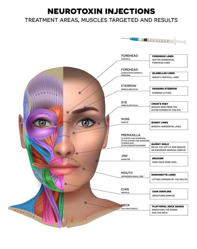 Neurotoxin injections