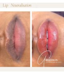 Lip Neutralisation
